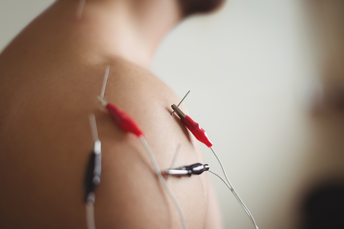 Neuromodulación Neuromodulación
